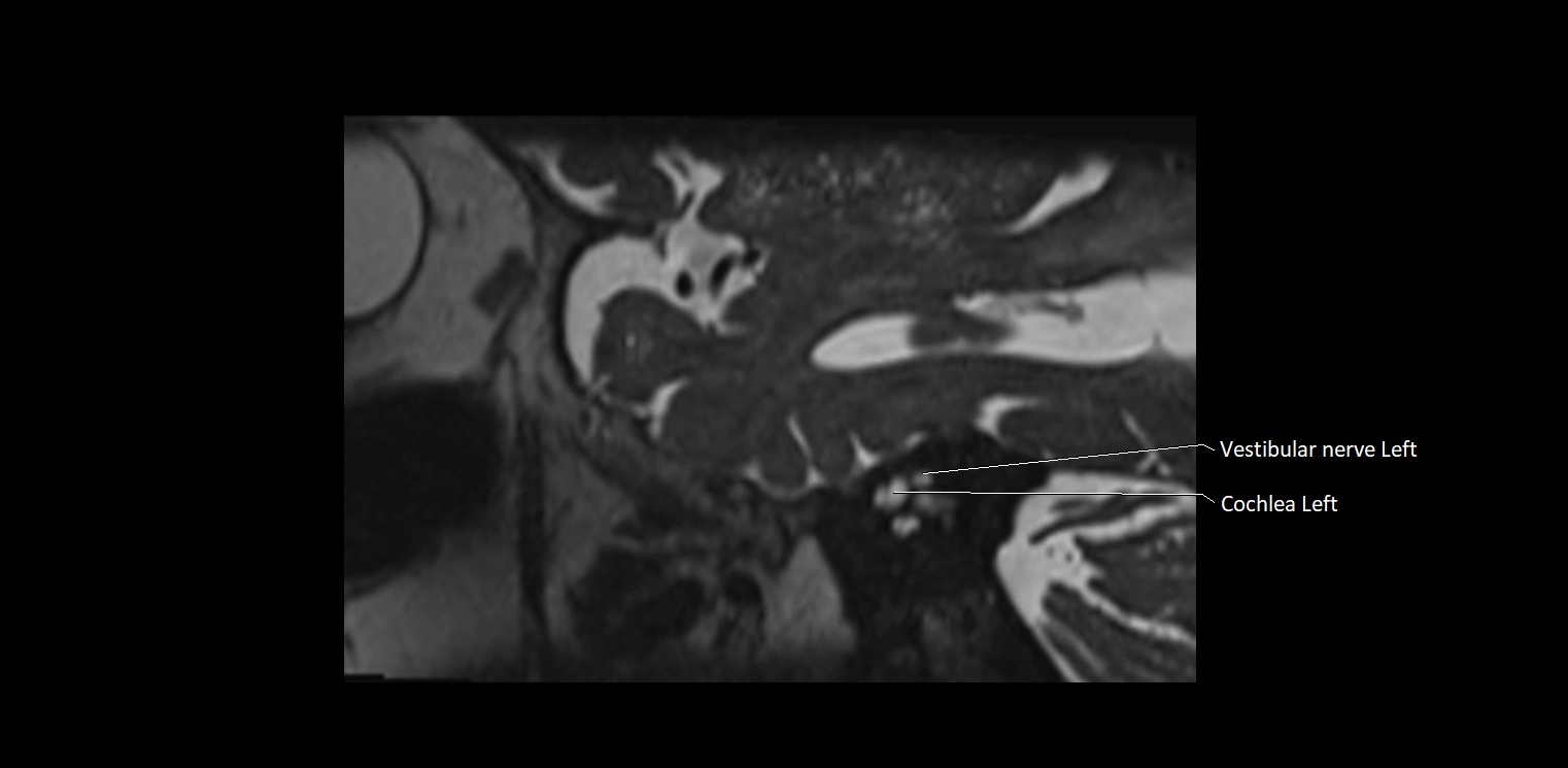 Cranial nerve sagittal anatomy MRI 3T image 7.webp